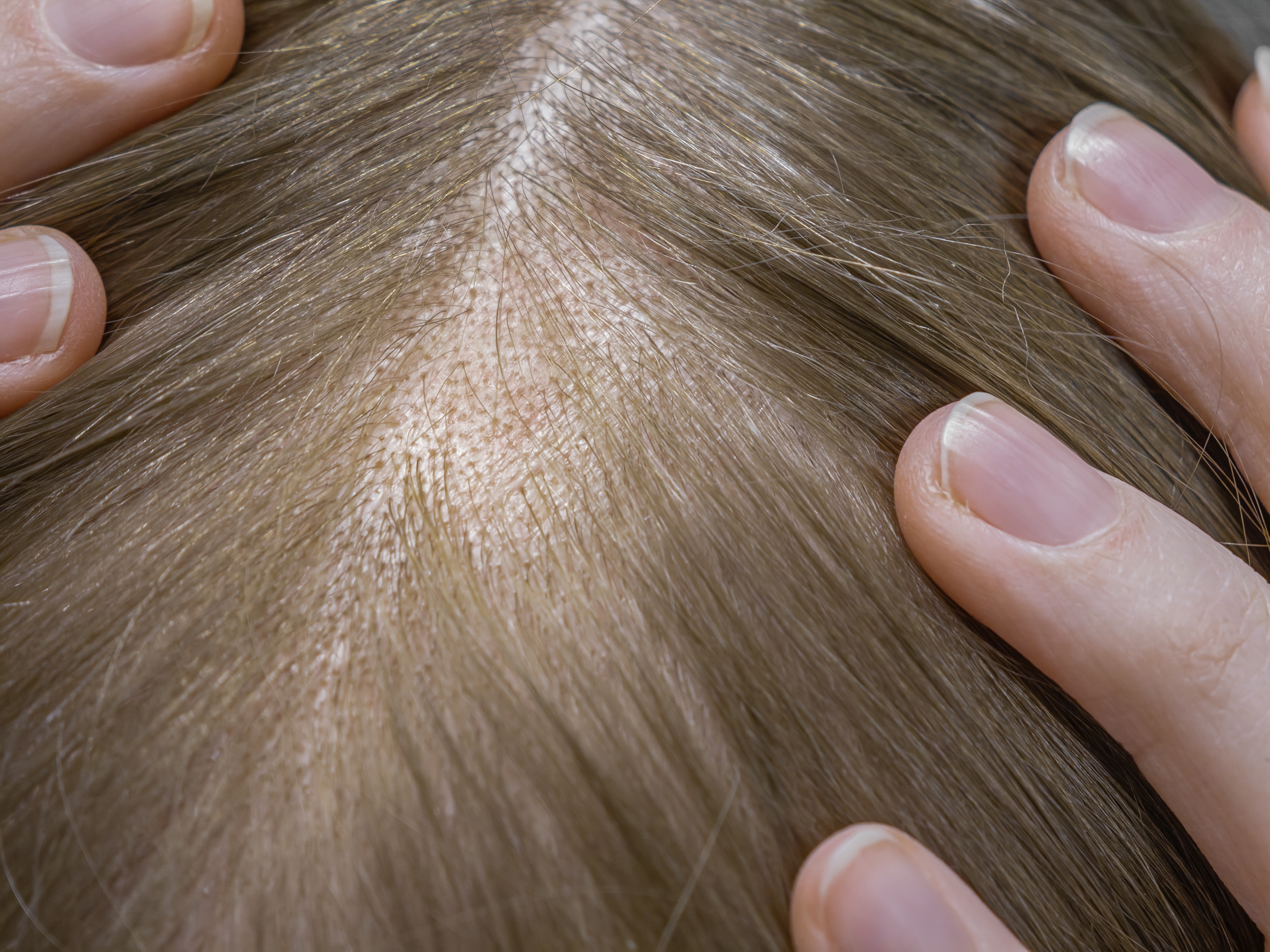 Haaruitval bij vrouwen: oorzaken en wat je eraan kunt doen