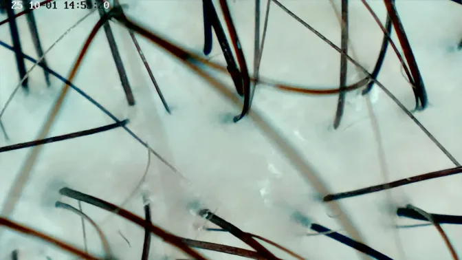 Hoofdharen scan na een behandeling