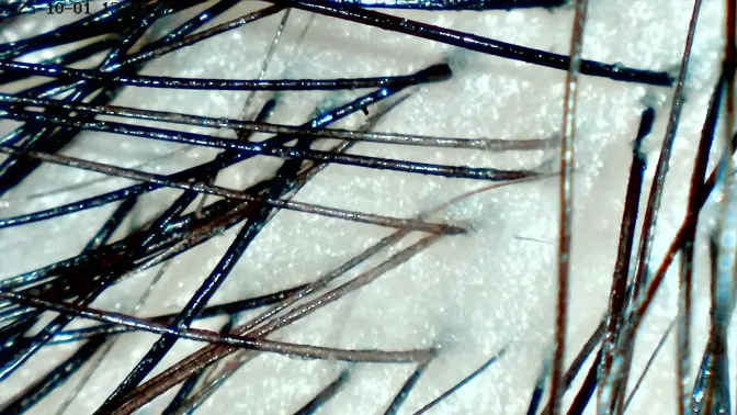 Hoofdharen scan voor een behandeling